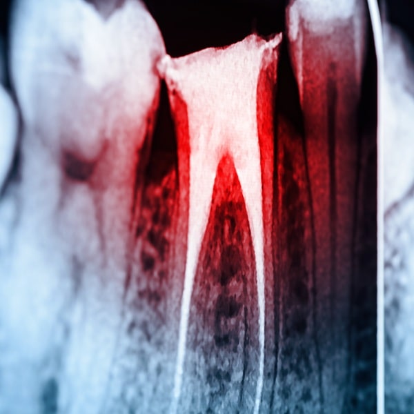 how-it-works-root-canal