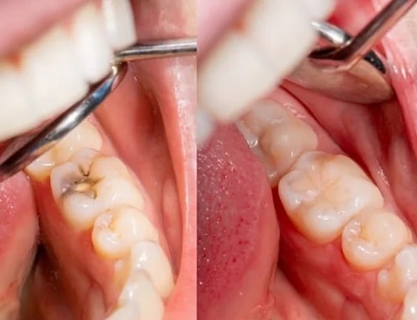 why-patients-prefer-composite-fillings